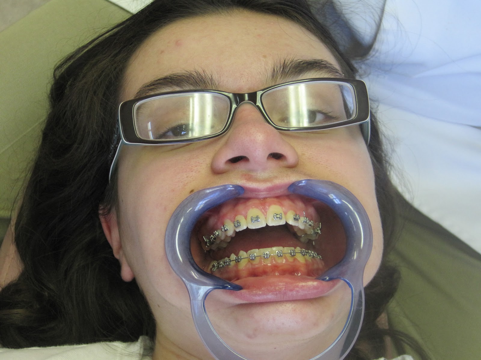 They are holding her mouth wide open to get at all her braces. 
