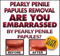 Pearly Penile Papules Removal Easy