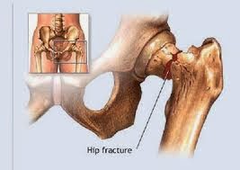 Cara Menyembuhkan Osteoporosis Cara Menyembuhkan Osteoporosis