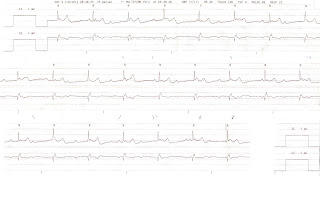 Stemi Strip