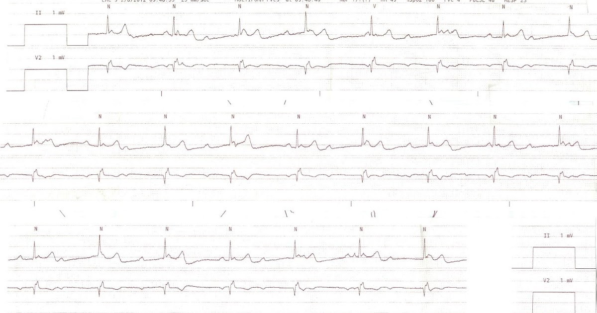 Dr. Smith's ECG Blog Intermittent third degree heart block due to
