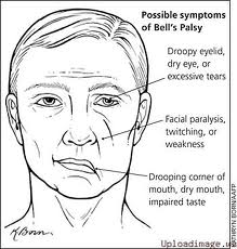 TERAPI WAJAH (BELL'S PALSY)