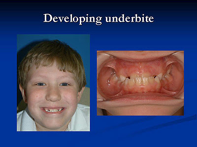 Baby Underbite