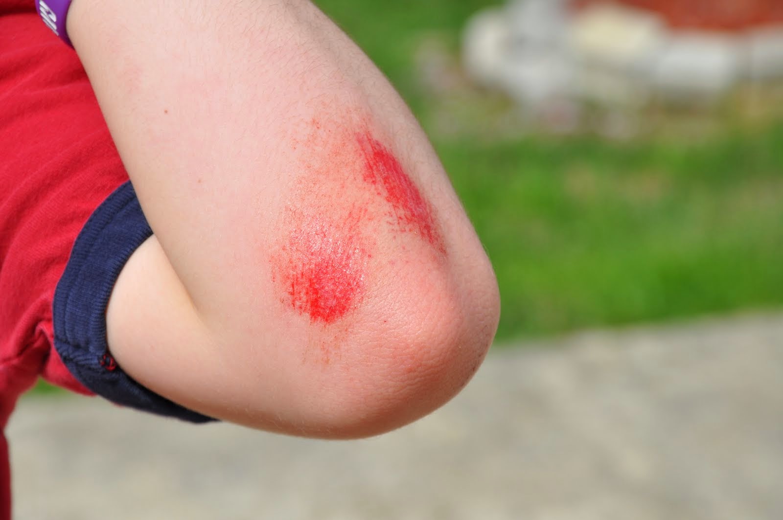 BABY CARE First Aid Care for Minor Scrapes and Cuts