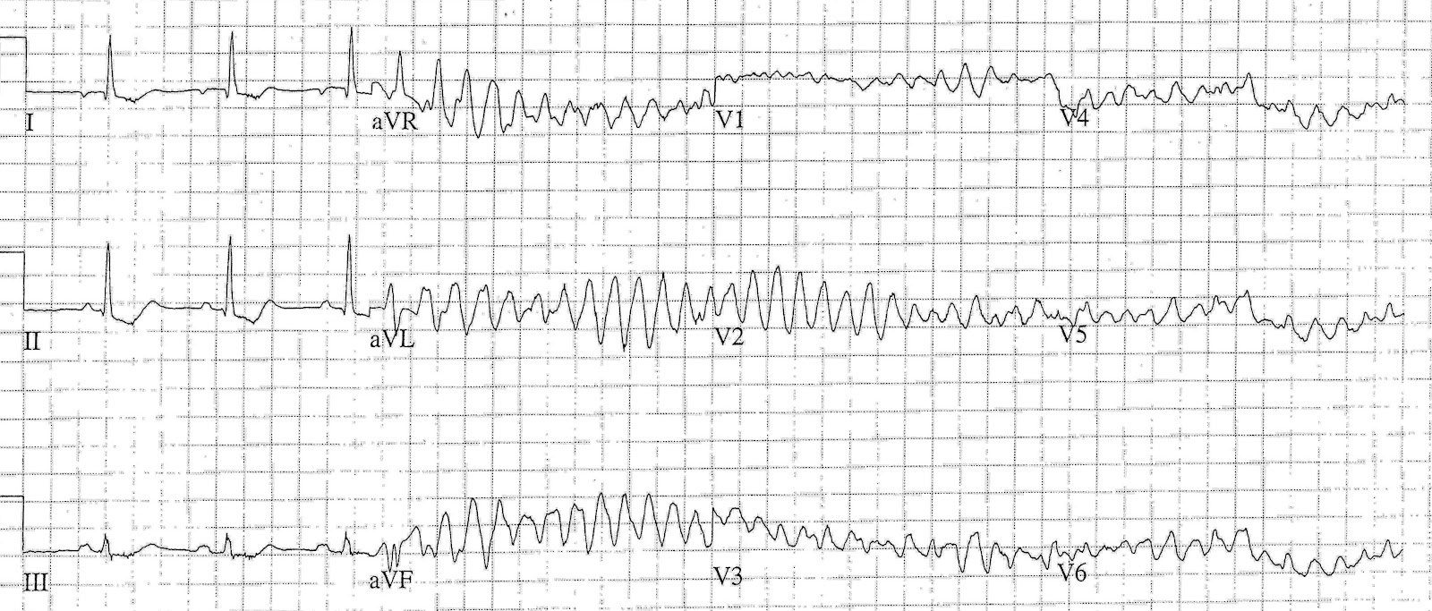 p mitrale ekg