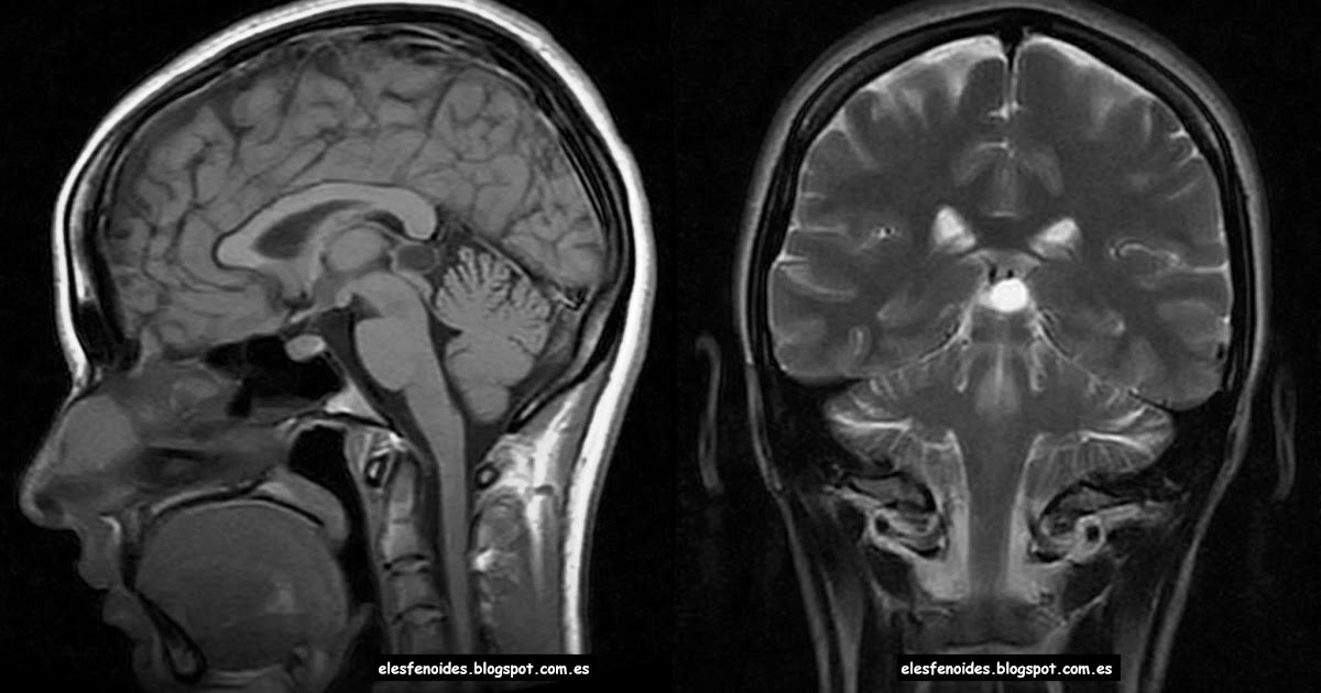 El esfenoides: Quiste pineal. 2 imágenes 1 caso.