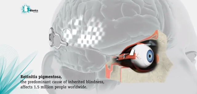 Bionic Eye Prototype Bionic Eye Prototype