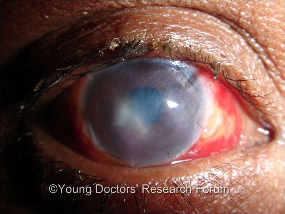 healing corneal ulcer