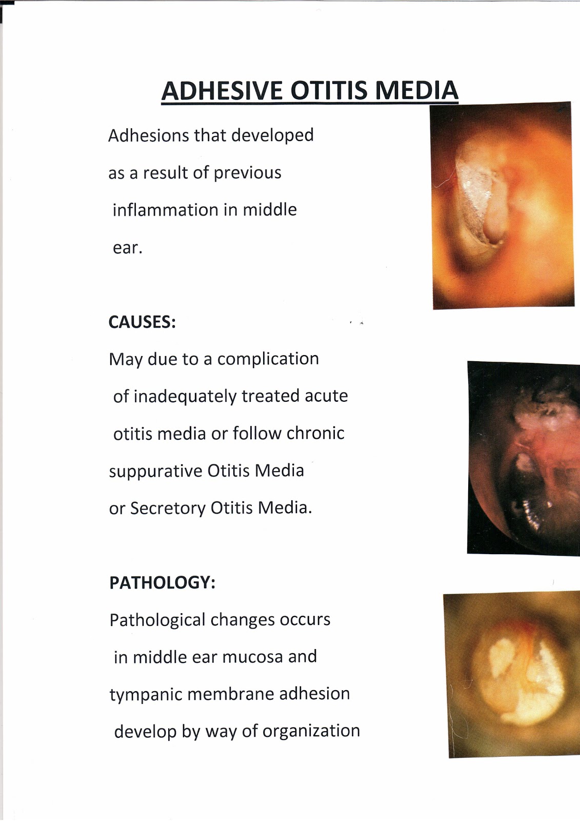 المدونة الطبية د.فهيد سالم السبيعي ADHESIVE OTITIS MEDIA
