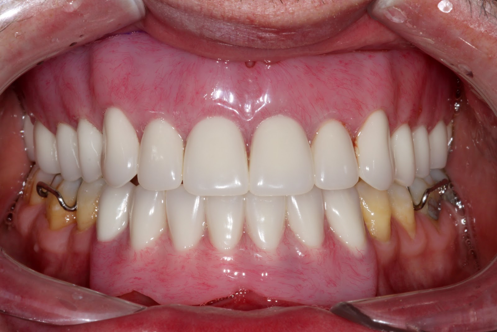 Boise Idaho Prosthodontics True Immediate Maxillary Complete Denture