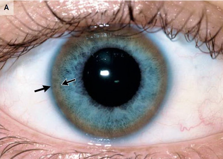 Kyle W Honors Biology Blog Wilson's disease