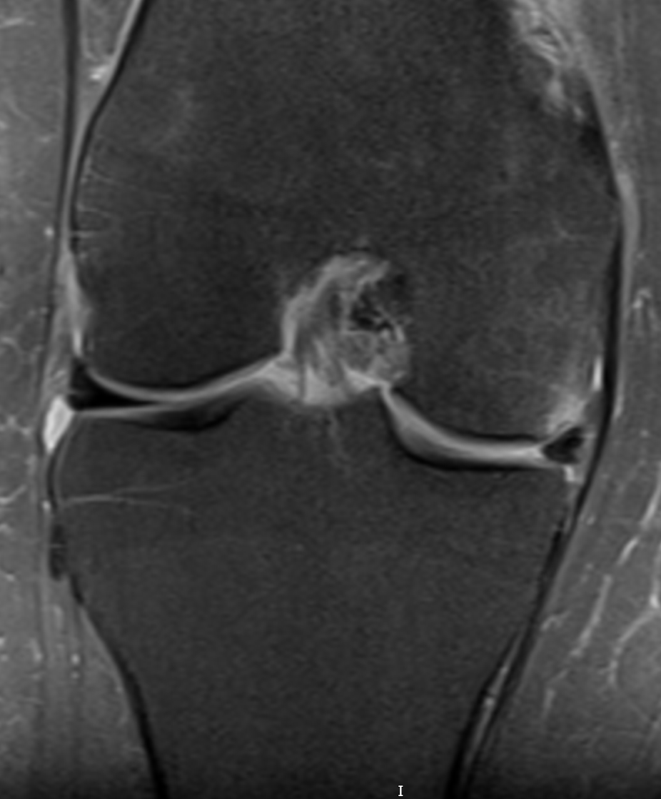Dont Delay The Critical Window For Treating A Complex Tear Of Medial Meniscus - bov1y4e