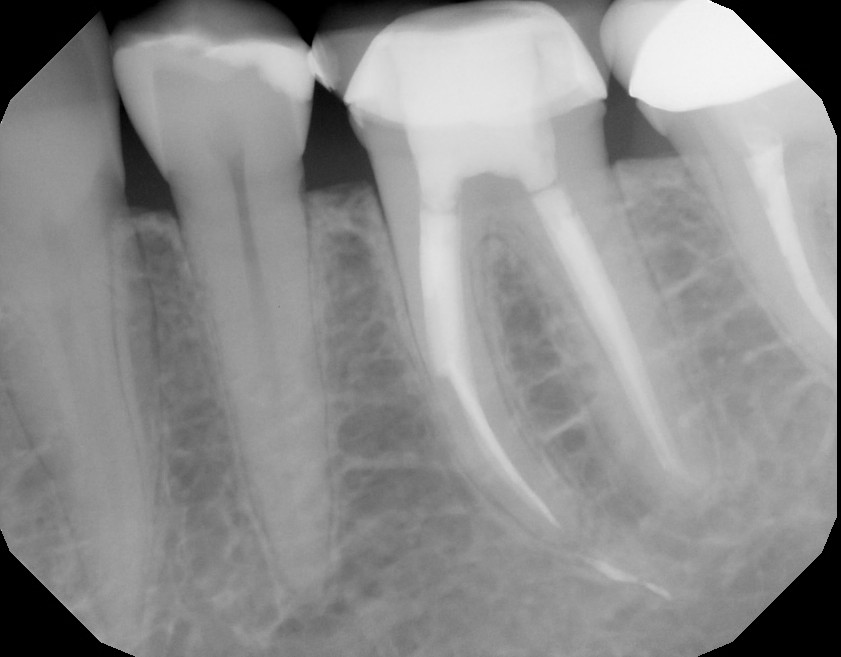 The Endo Blog CBCT as Aid In Removal of Separated File
