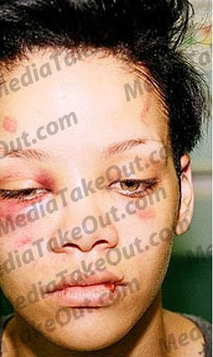 rihanna face beat up. New Pics Of Rihanna Injured