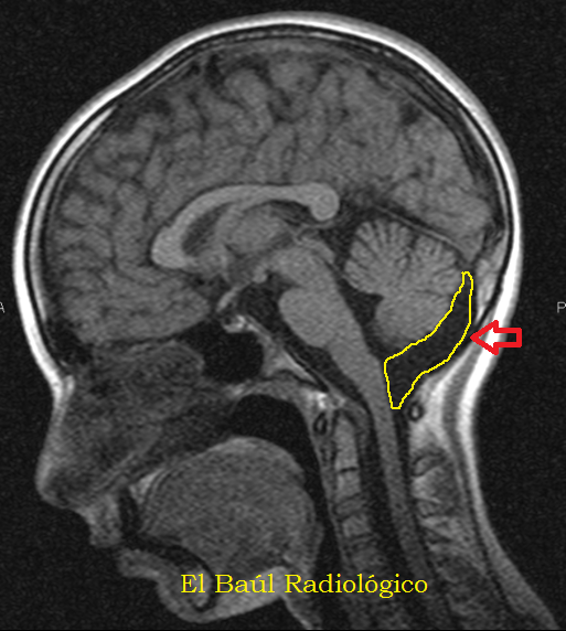 de la Cisterna Magna son