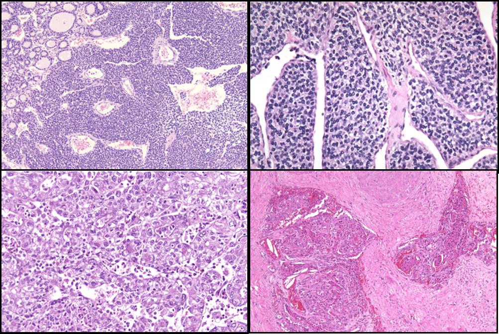 Poorly Differentiated Adenocarcinoma