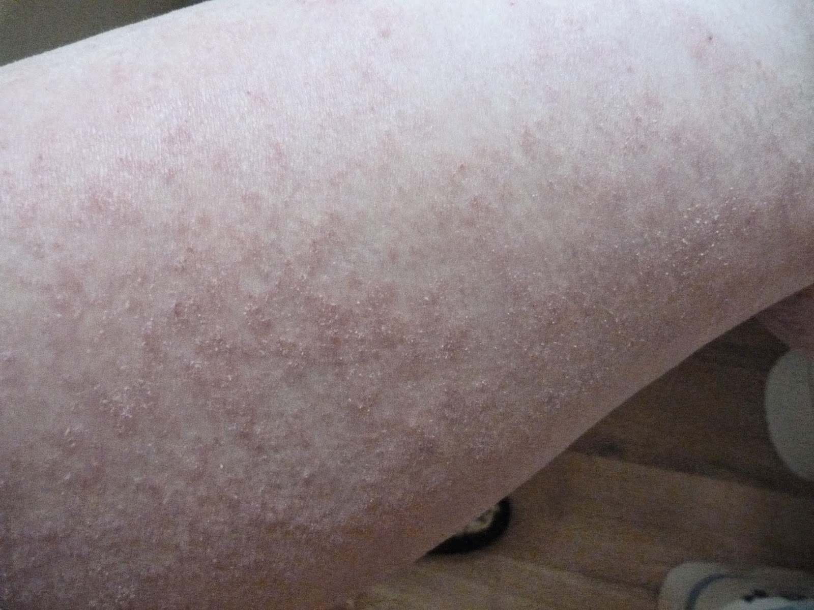 I Have Eczema 13.5 Month Photos