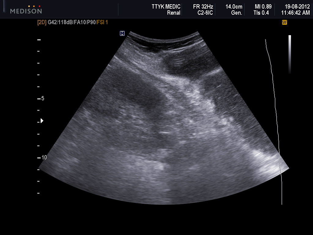 VIETNAMESE MEDIC ULTRASOUND: CASE 136: COLD ABSCESS, Dr PHAN THANH HẢI