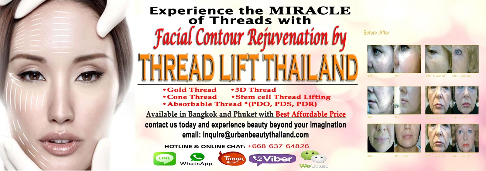 Best Promo Thread Lift Thailand Urban Beauty Thailand Thread Lift Thailand FAQs