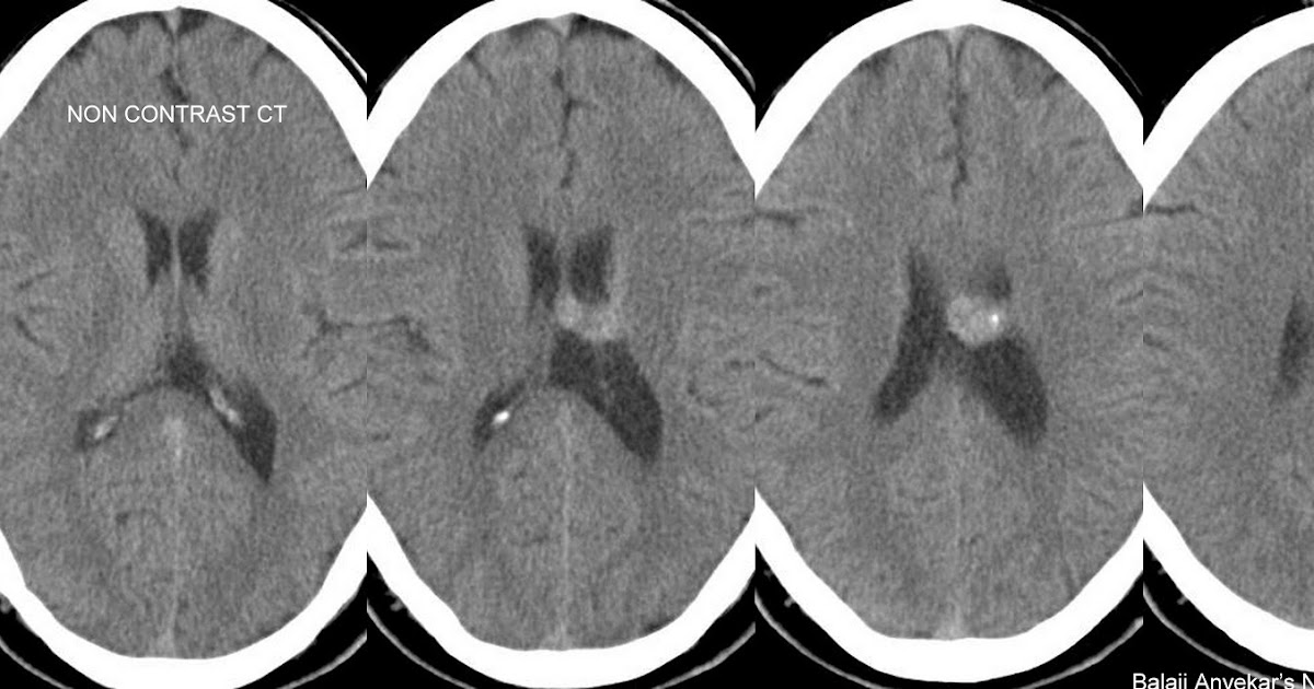 Neuroradiology Cases: Intraventricular Cavernoma