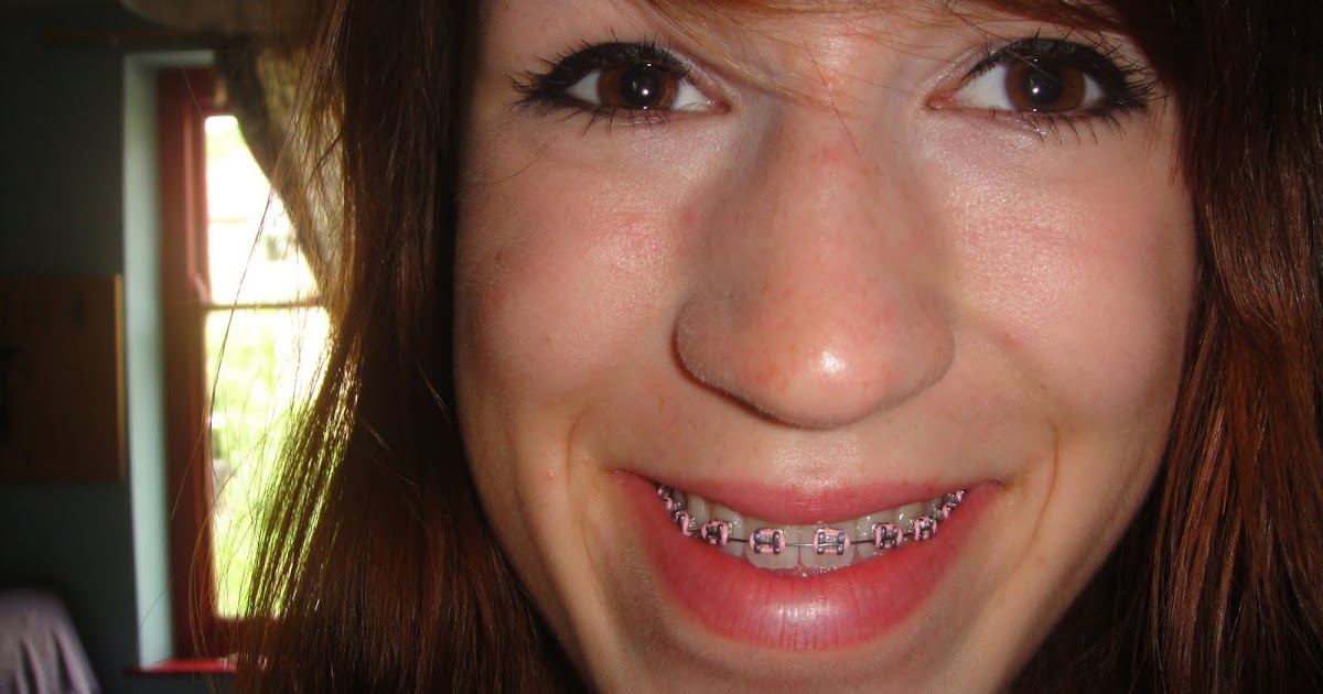 Rosa's Jaw Surgery Story top brace is on!!