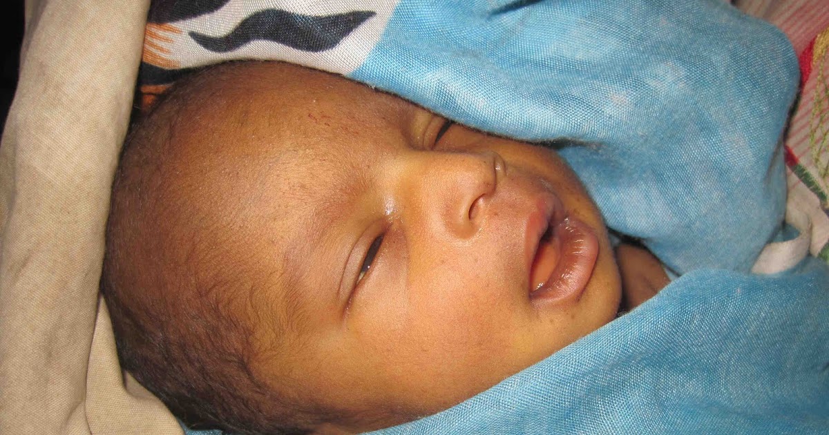 Midwife on a Mission! Jaundice The Color of Kernicterus