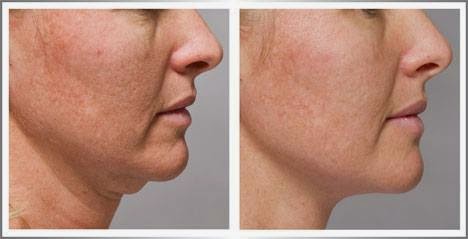 Before & After Image of Dermaheal- Fat Dissolving Injection Treatment
