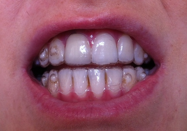 invisalign attachments