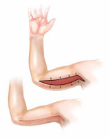 Upper arm lift cheap upper arm lift UK