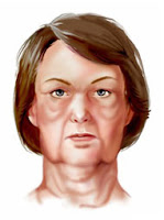 Face lift surgery UK Cheap face lift abroad