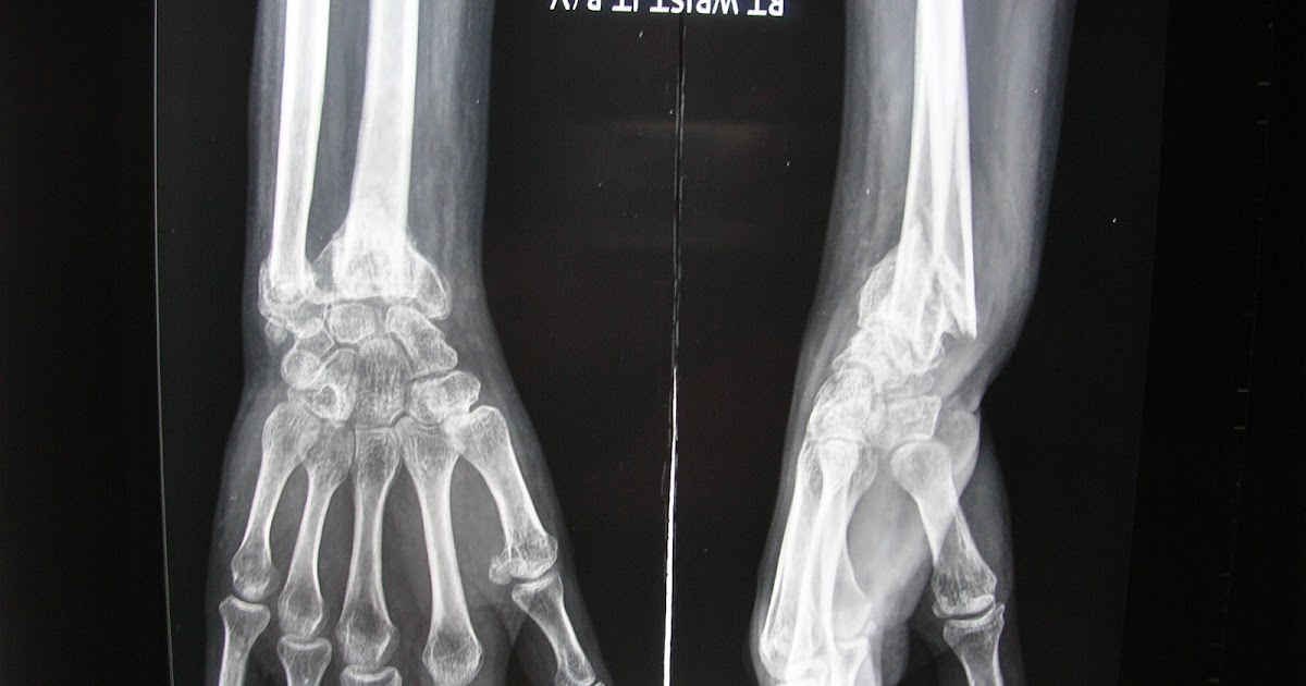 Xrays and Slides malunion of distal radiusulna fracture with