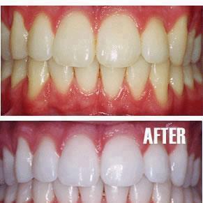 معلومات الطريقة الافضل لتبييض الاسنان