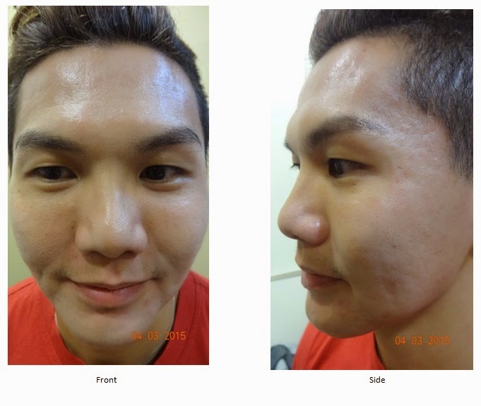 Jason Julius Lim Road To Better Complexion Venus Viva Treatment Part 1