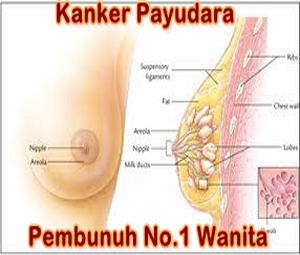 kanker-payudara