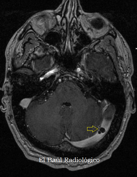 El Baúl Radiológico 2) GRANULACIONES ARACNOIDEAS EN LOS SENOS VENOSOS