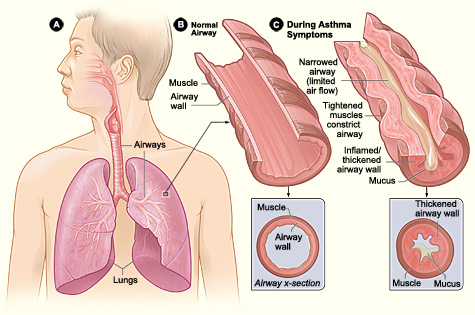 asthma bronchial