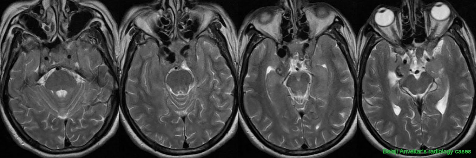 This MRI study of brain shows: An abnormal enhancing soft tissue in sellar ...