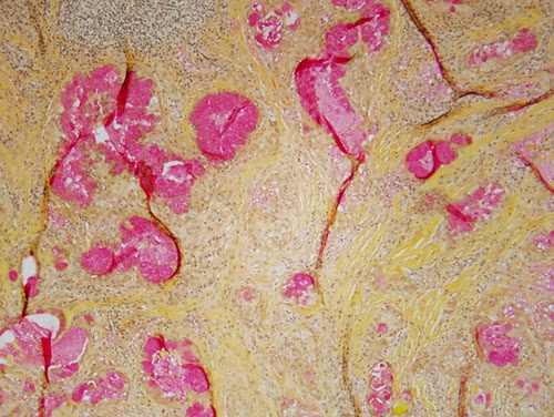 Carcinoma Mucoepidermóide Estomatologia Online