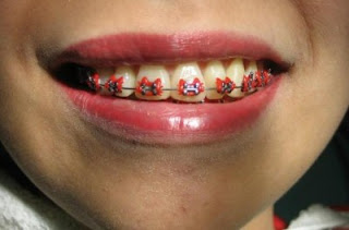 Hello Kitty braces