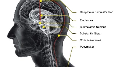 pain Atypical brain facial stimulation deep