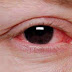 Penyebab dan Cara Mengobati Mata Merah Pada Anak