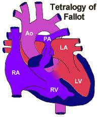 Risk for Decreased Cardiac Output related to Tetralogy of Fallot