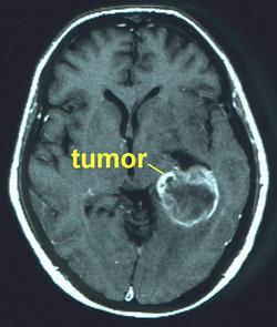 brain tumor stages some characterized abnormal cells tumors basically uncontrolled growth