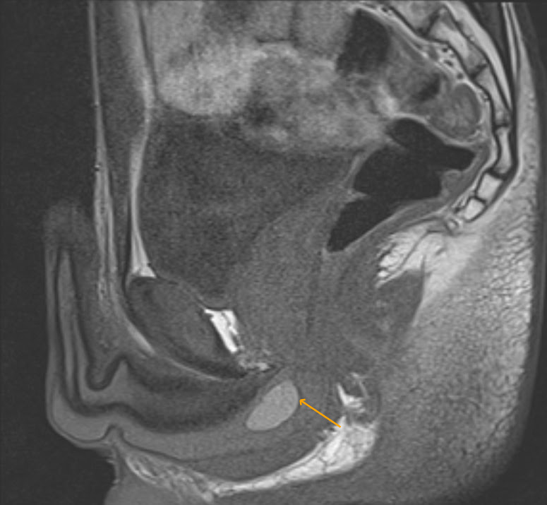 mricases: Cowper's duct cysts