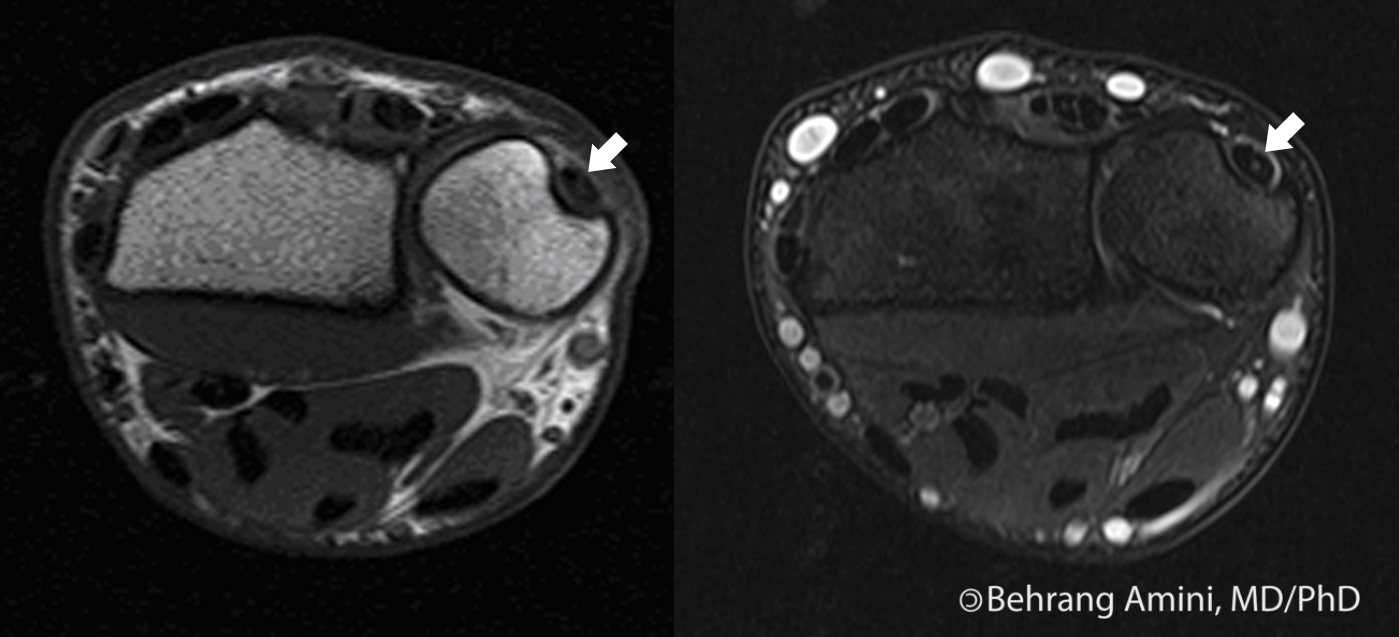 Roentgen Ray Reader Extensor Carpi Ulnaris Tendon Normal Signal Intensity