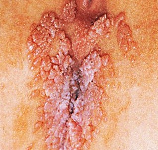 Remove and Prevent Genital Warts from Recurring -- Keyouwang 