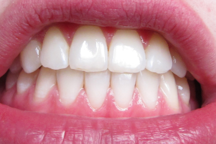 Braces Off Stains