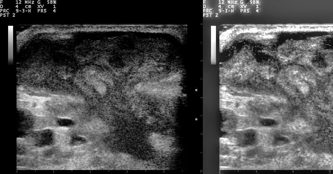 Nevit's blog Ultrasound image of breast abscess. Original version and