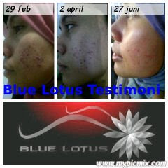 Blue Lotus Acne Skin Care