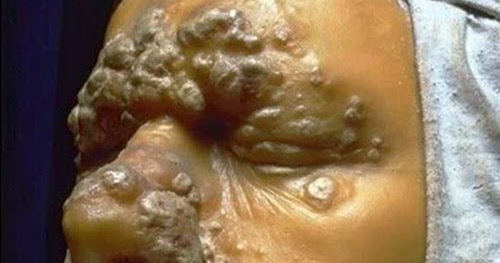 ZUL ZIE Textile: PENYAKIT SIFILIS DI BAHAGIAN TUBUH ANDA&hellip;&hellip;&hellip;&hellip;&hellip;